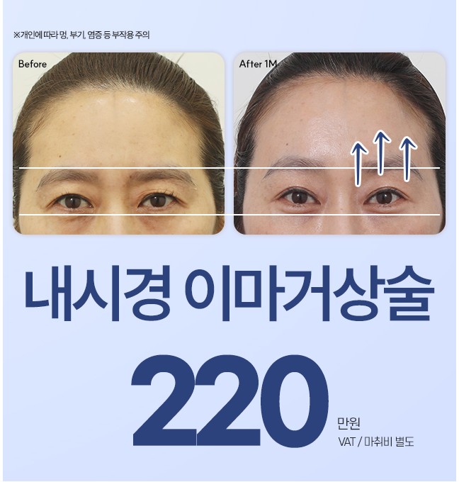 11월 내시경이마거상술 이벤트