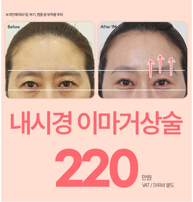 10월 내시경이마거상술 이벤트